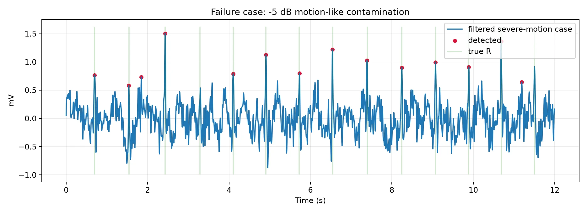 ECG detections and reference beats during severe motion-like contamination at minus five decibels